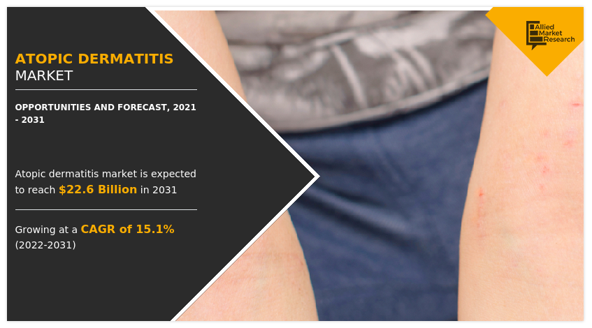 Atopic Dermatitis Market, Dermatitis Atopica Market, Atopic Dermatitis Market Size, Atopic Dermatitis Market Share, Atopic Dermatitis Market Analysis, Atopic Dermatitis Market Opportunity, Atopic Dermatitis Market Growth, Atopic Dermatitis Market Trends, Atopic Dermatitis Market Forecast