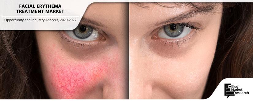 Facial-Erythema-Treatment