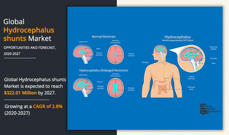 hydrocephalus-shunts-Market-2020-2027