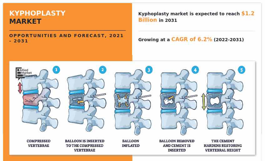 Kyphoplasty Market, Kyphoplasty Market size, Kyphoplasty Market share, Kyphoplasty Market trends, Kyphoplasty Market growth, Kyphoplasty Market analysis, Kyphoplasty Market forecast, Kyphoplasty Market opportunity