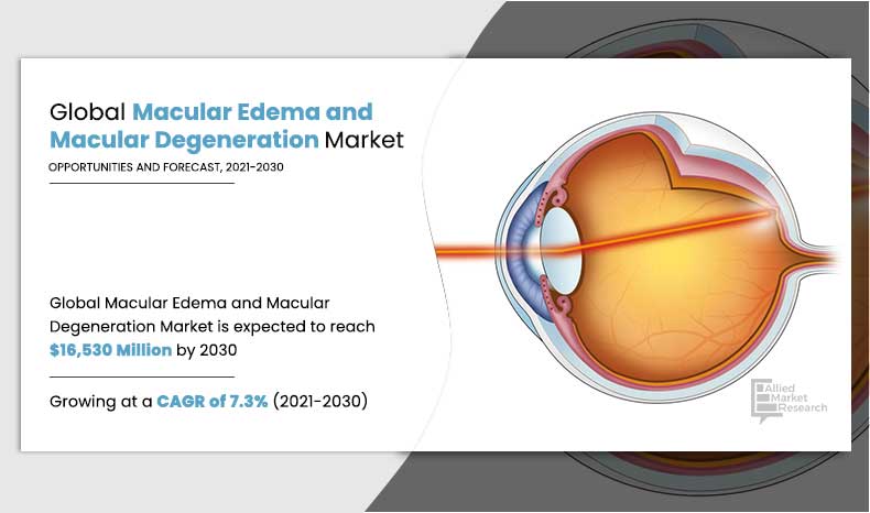 Macular-Edema-and-Macular-Degeneration-Market,-2021-2030