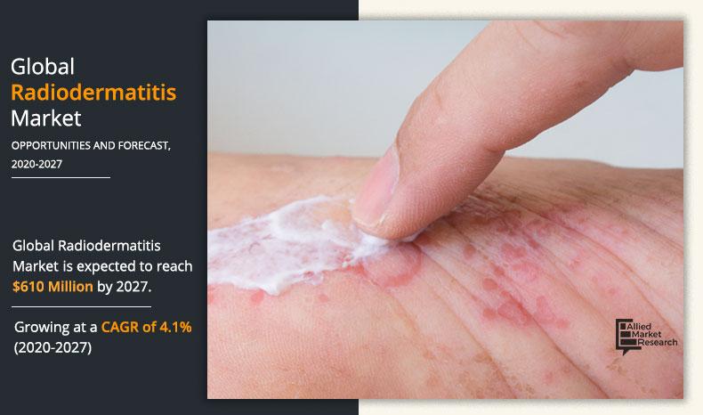 Radiodermatitis-Market-2020-2027