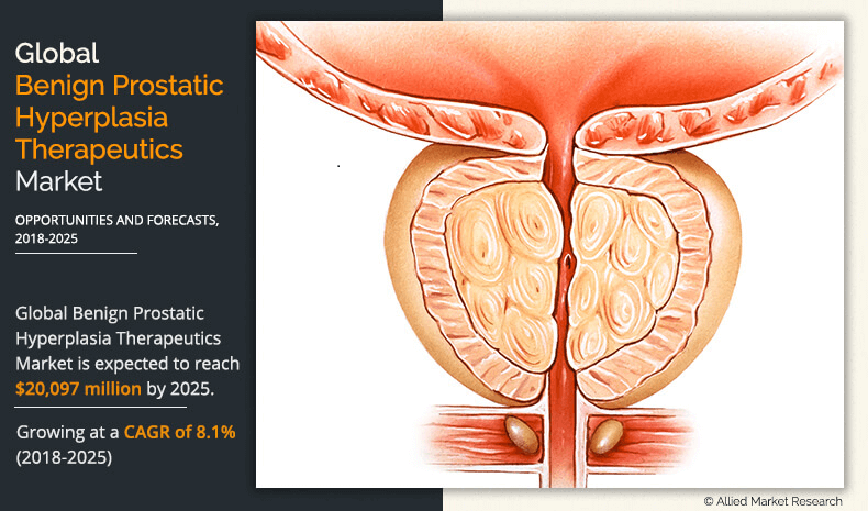 benign prostatic hyperplasia (bph) is characterized by A prosztatitis kezelése 28 év alatt